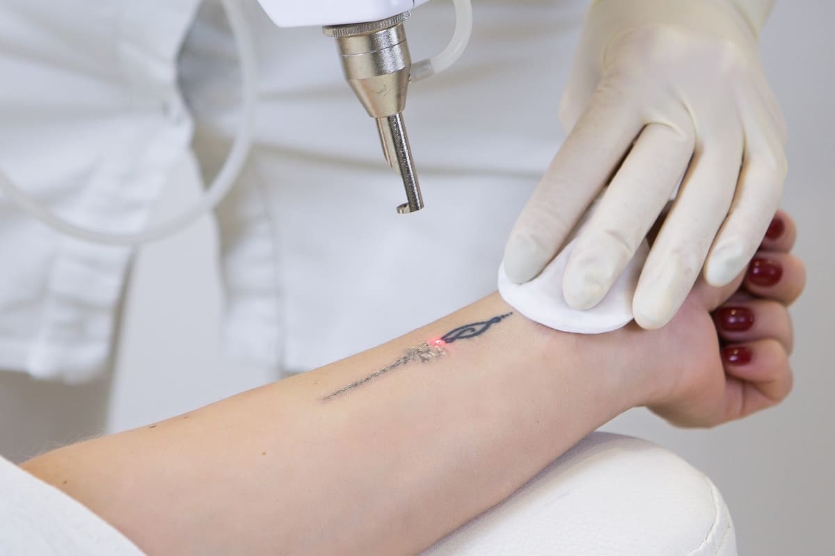 Pico Laser 2000 Watt | Laser Tattoo Removal Equipment For Professional –  United Skin Care