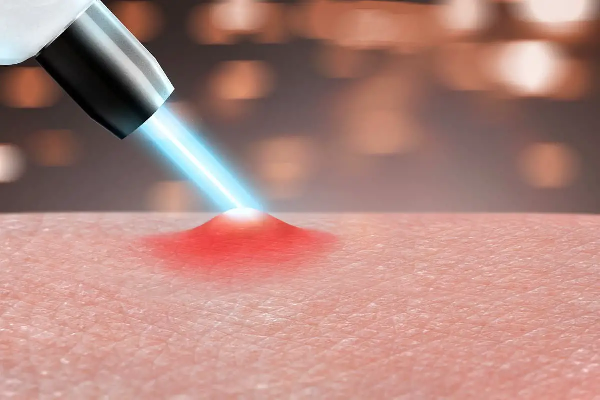 Laser Tattoo Removal Calgary | The Injectionist & Aesthetics