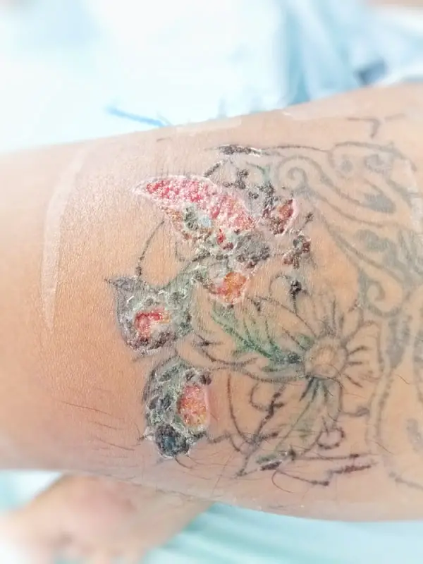 Tattoo Infection: Everything You Need To Know - Saved Tattoo