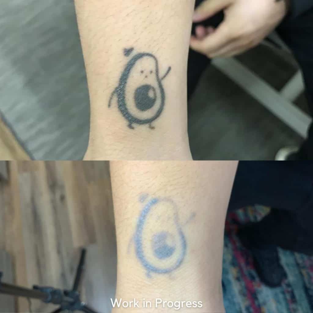 Laser Tattoo Removal Before and After: Ultimate Guide 2023 - Saved Tattoo