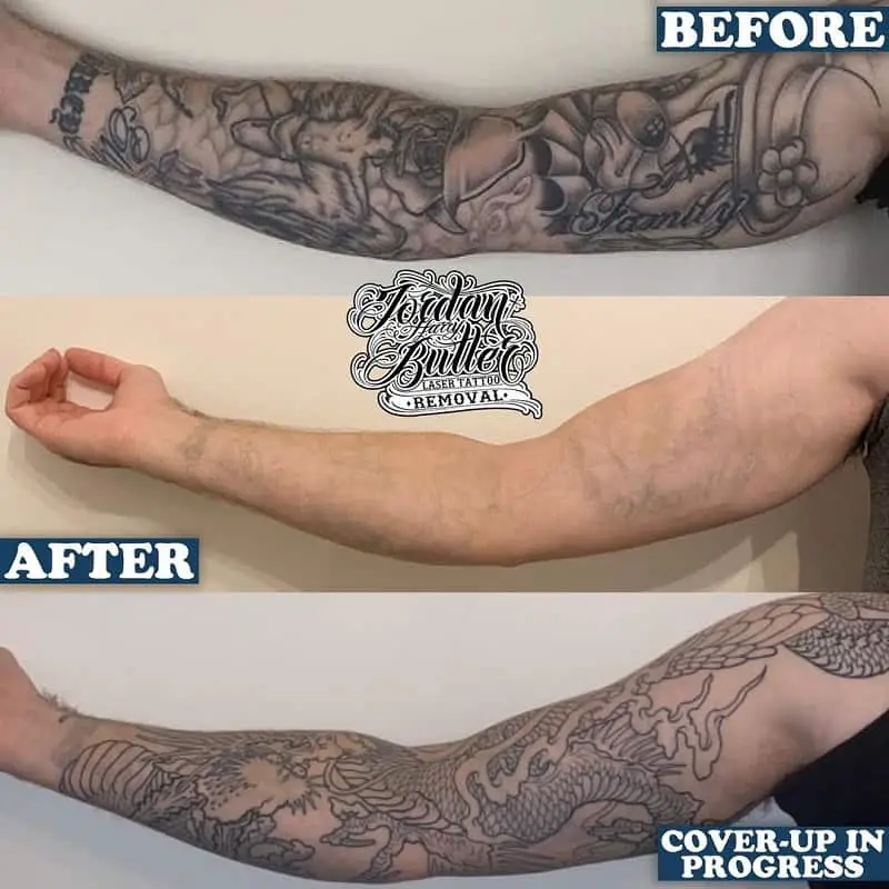 laser tattoo removal and cover up with a new tattoo