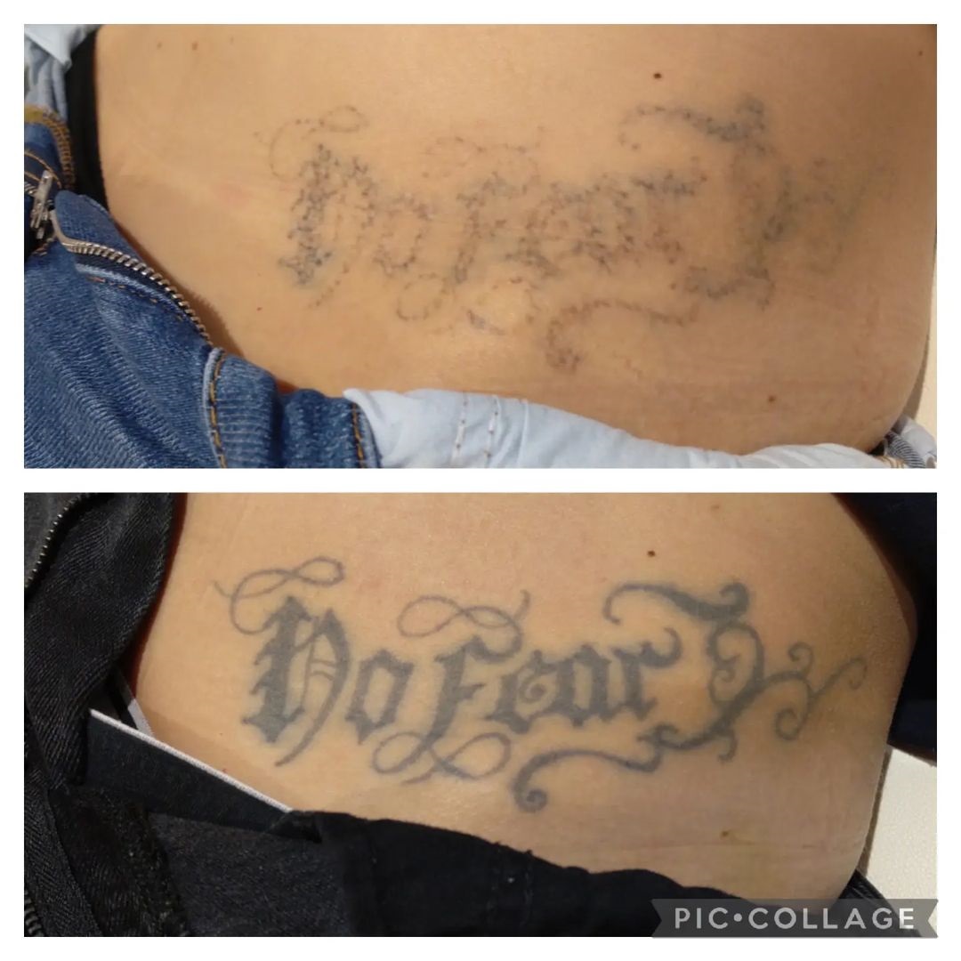 Tattoo Removal Scarring – A Different Problem!
