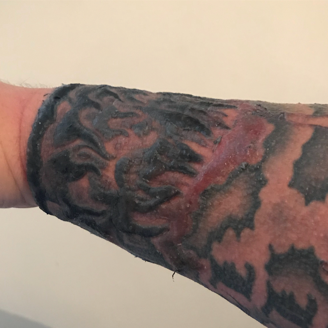 Tattoo Narben Bilder